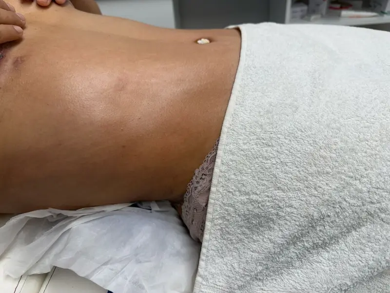 Adiós al dolor post-cirugía con los masajes postoperatorios