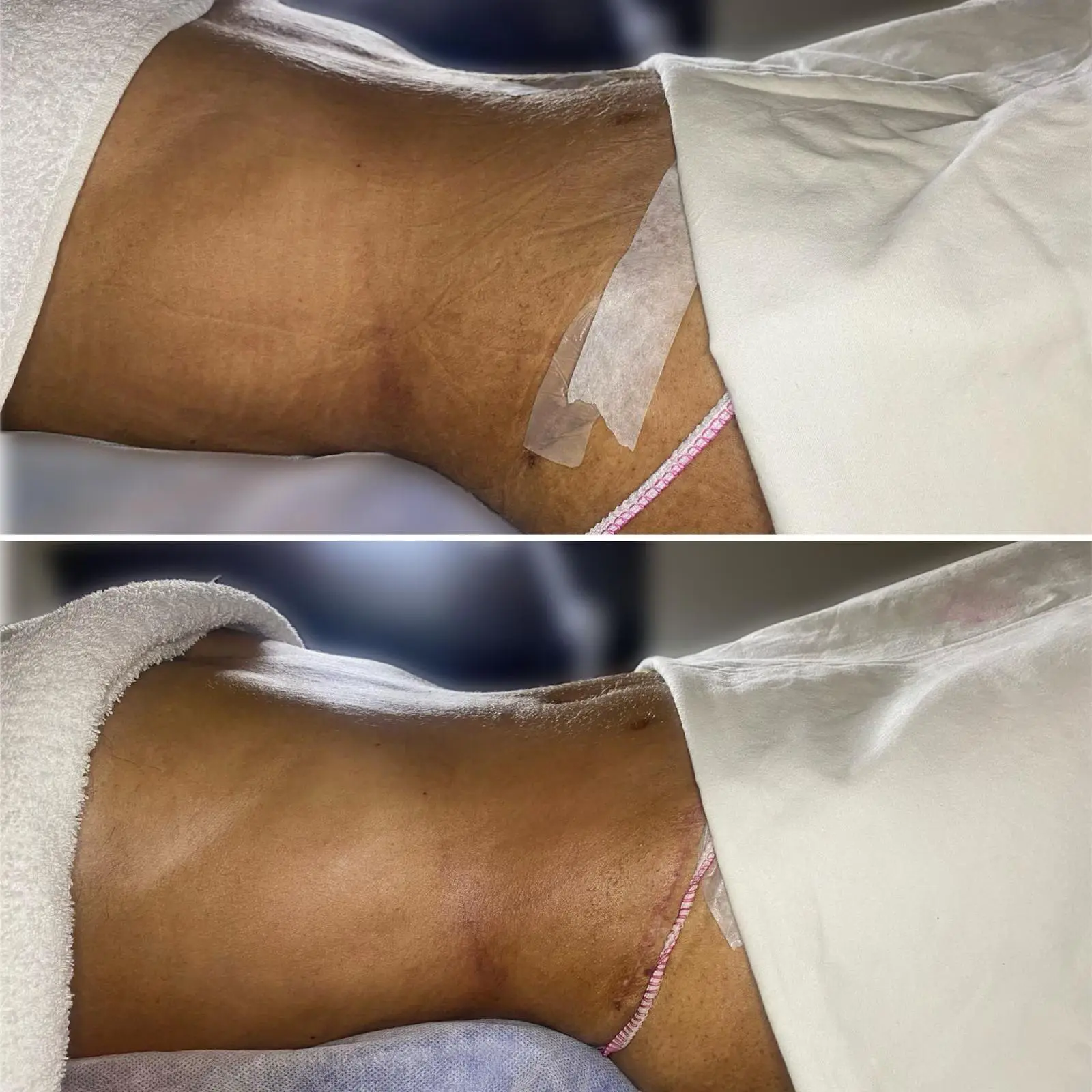 Recuperación postcirugía con tu especialista en masajes postoperatorios 