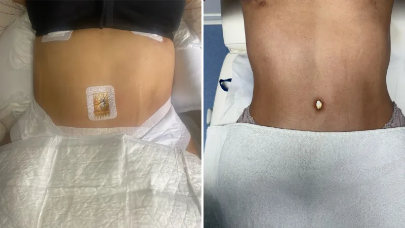 Masajes postoperatorios en Barcelona ¡Alivio rápido, recuperación óptima!