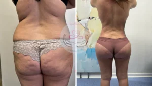 Lipotransferencia BCN ¡Tu guía para resultados duraderos!