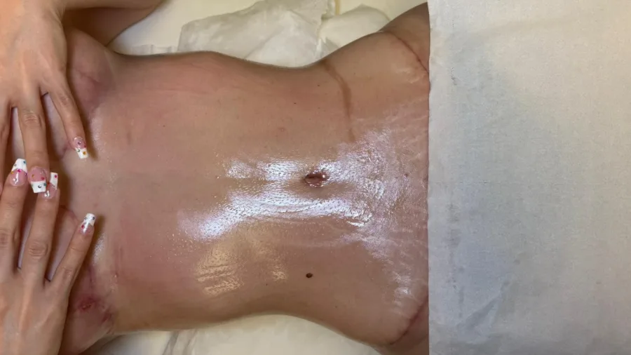 Masajes post-operatorios en Barcelona para recuperar tu sensibilidad