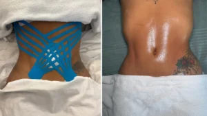 Masajes postoperatorios en Barcelona que transforman tus cicatrices