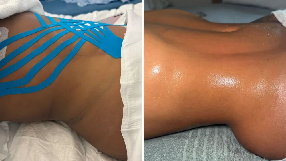 Resultados de masajes postoperatorios en Barcelona, abdomen con vendaje neuromuscular y piel tersa post-tratamiento.
