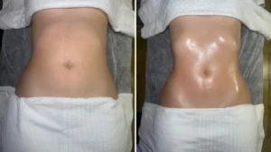 4 señales clave de tu cuerpo que pide un drenaje linfático brasileño con el Método Thais Leon en Barcelona