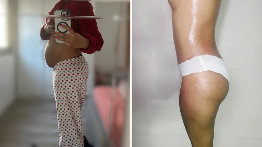 Recuperación estancada Tu especialista en masajes postoperatorios en Barcelona te ayuda