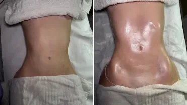 que-pasa-despues-liposuccion-masajes-postoperatorios-barcelona