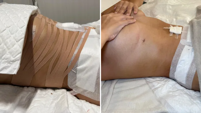 Masajes postoperatorios en Barcelona realizados por especialista, con aplicación de vendaje neuromuscular (taping) para favorecer la recuperación tras cirugía estética