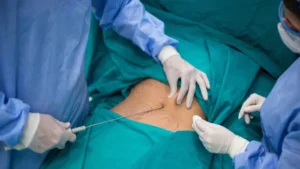 Drenaje linfático postoperatorio inmediato ¡Recuperación exitosa!