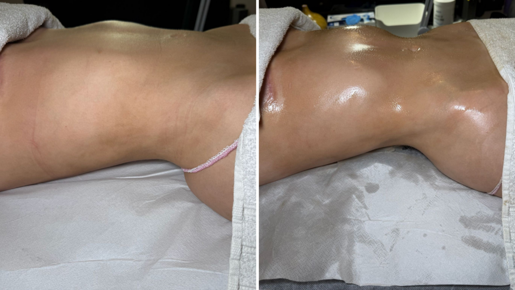 Drenaje linfatico Brasileño con el metodo Thais Leon