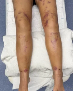 ¿Inflamación tras cirugía de Lipedema? Lo que nadie te cuenta.