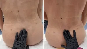 Evolución del Seroma, ¡no dejes que el líquido se vuelva fibrosis!