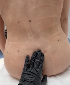 Seroma postoperatorio? Elimina el líquido sin dolor en Barcelona.