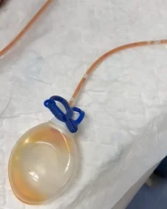 ¿Punción o drenaje linfático? Lo que nadie te cuenta sobre el seroma