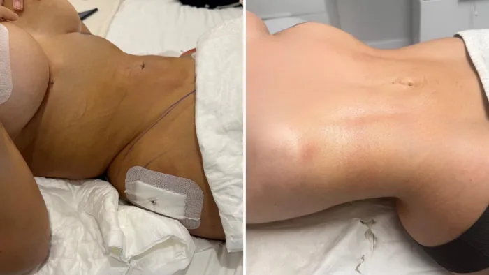 Cómo eliminar la fibrosis después de una cirugía estética