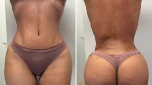 Cómo preparar tu cuerpo antes de una cirugía estética en Barcelona