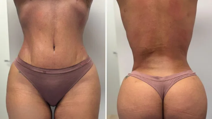 Cómo preparar tu cuerpo antes de una cirugía estética en Barcelona