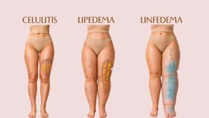 ¿Cómo saber si tengo el lipedema o celulitis? Las diferencias que nadie te cuentan 