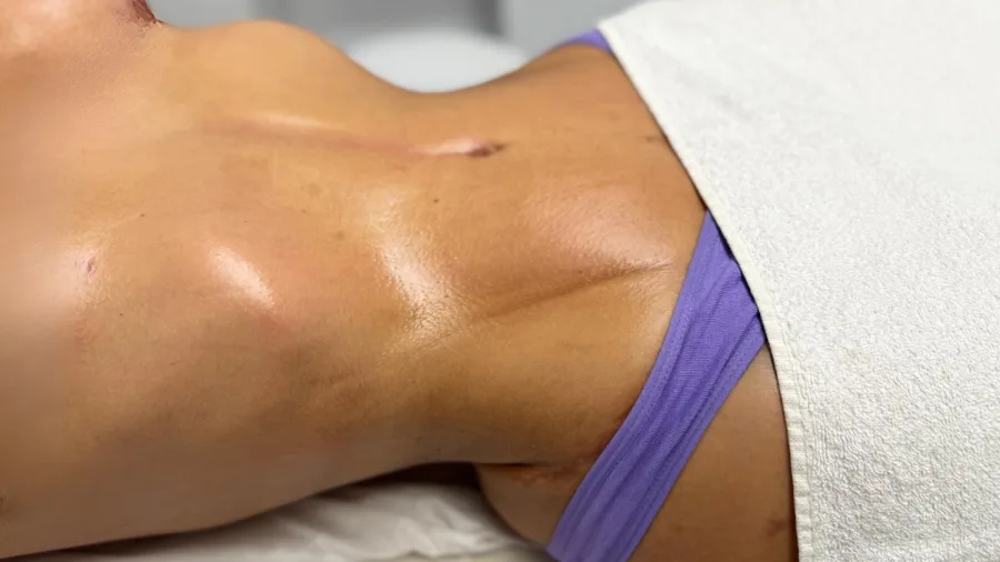 Cómo cuidar tu cicatriz después de una cirugía estética